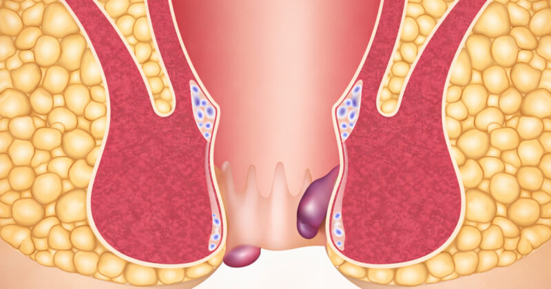 סימנים לטחורים