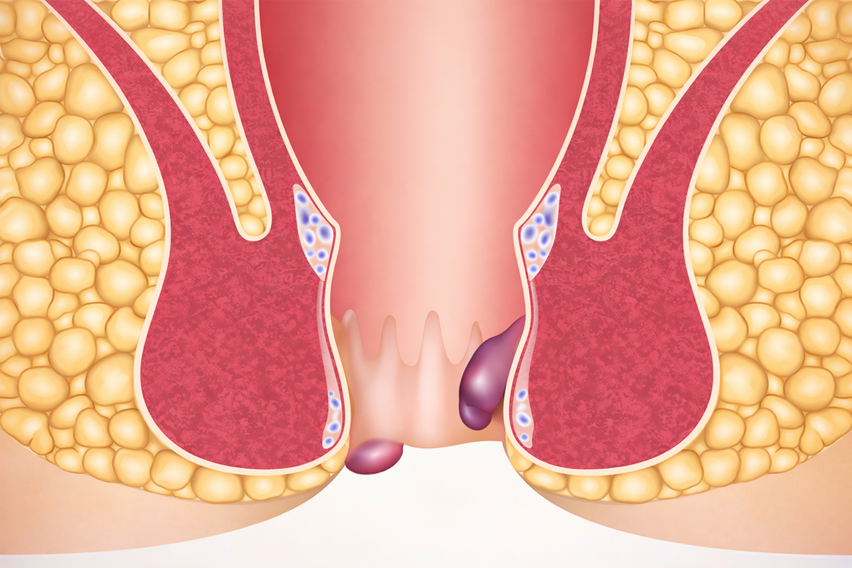 סימנים לטחורים