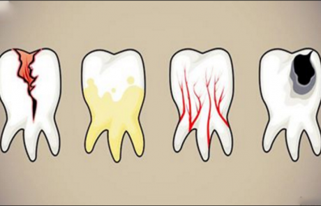 7 המזונות הגרועים ביותר לשיניים שלנו … והתחליפים הבריאים שלהם !