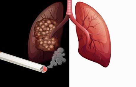 10 המחלות הקטלניות הנגרמות עקב העישון