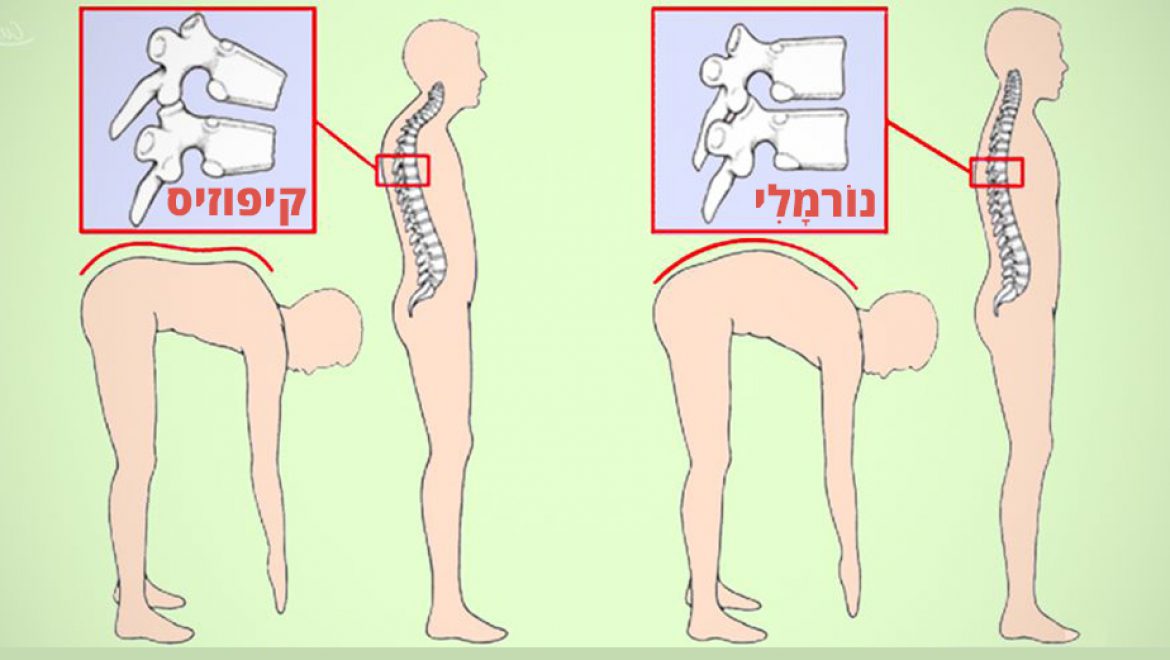מה הם הגורמים לגיבנת (קיפוזיס)