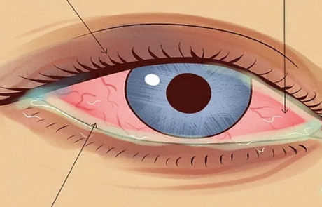 האם העיניים שלכם אדומות, צורבות ודומעות כל הזמן? זו יכולה להיות הסיבה