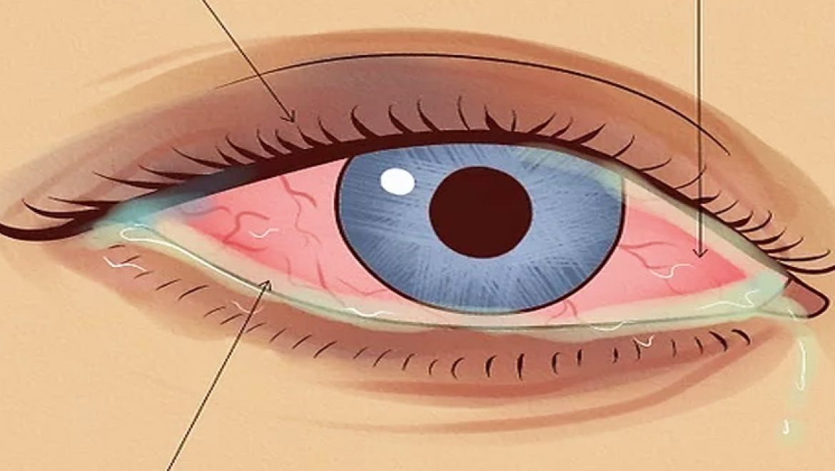האם העיניים שלכם אדומות, צורבות ודומעות כל הזמן? זו יכולה להיות הסיבה