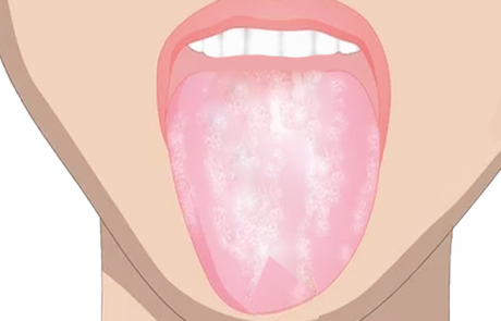 5 דברים שלשון לבנה יכולה לחשוף על בריאותכם