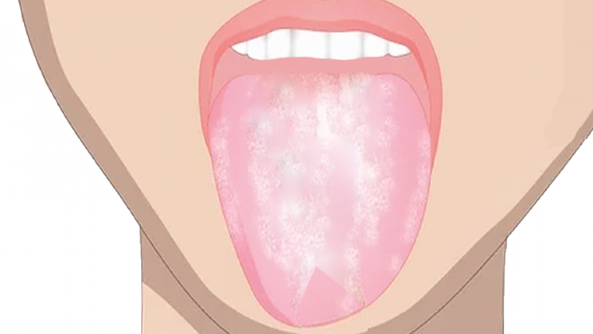 5 דברים שלשון לבנה יכולה לחשוף על בריאותכם
