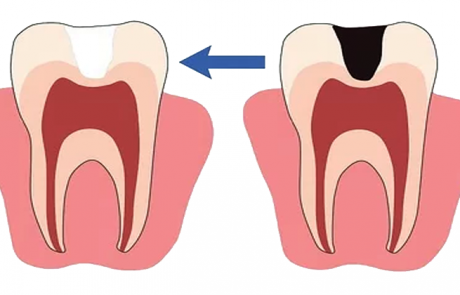 5 סיבות שהשיניים שלכם רגישות עד כדי כאב