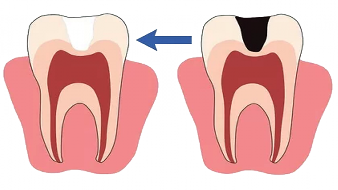 5 סיבות שהשיניים שלכם רגישות עד כדי כאב