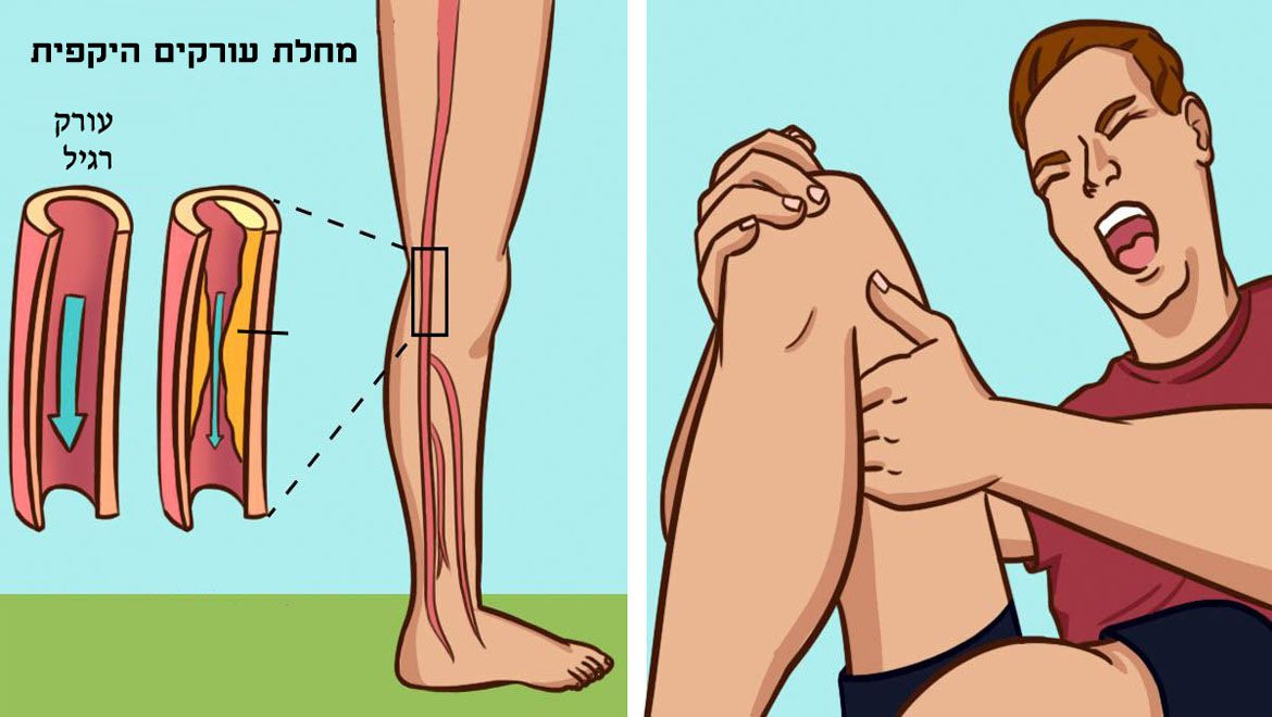 ממה נהיה מחלת עורקים היקפית והדרך להחזיר אותם לתיקונם