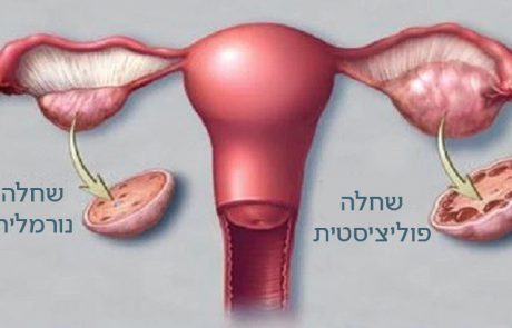 המתכונים הטובים ביותר עבור ניקוי ציסטות מהשחלות !