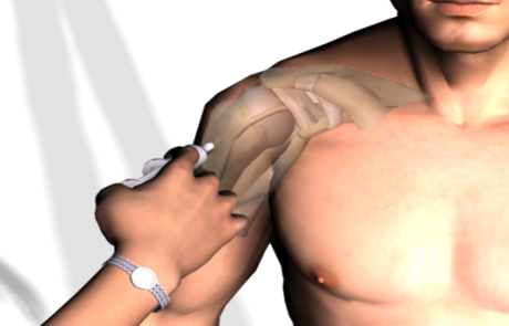האם אתם סובלים מכאבים בכתף? זה נקרא טנדיניטיס וכך תקלו על זה
