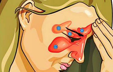 כיצד להקל על זיהום בסינוסים ולטפל באף סתום ב-15 שניות